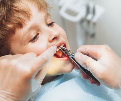 Pediatric Tooth Extractions for Kids in Beaverton, OR - Tooth + Tusk ...